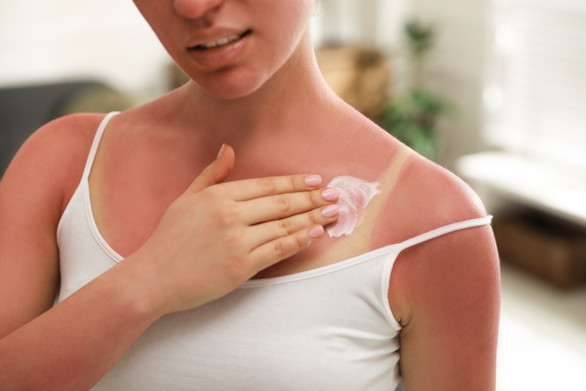 How to Calm Your Skin After Sunburn: The Avant Skincare Guide